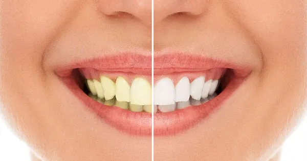 7 Benefits of Teeth Whitening By Cosmetic Dentist | Cathedral City 7 Benefits of Teeth Whitening By Cosmetic Dentist | Cathedral City