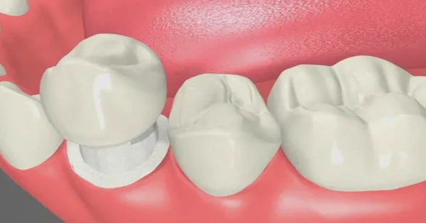 dental bridges and crowns Palm Desert dental bridges and crowns Palm Desert