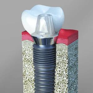 Dental Implants Rancho Mirage