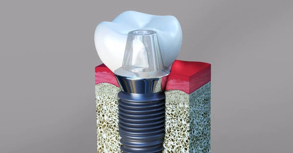 Dental Implants Palm Desert Dental Implants Palm Desert
