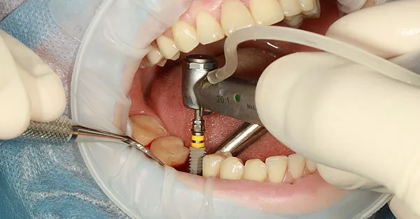 Do You Need Oral Surgeon for Dental Implants Do You Need Oral Surgeon for Dental Implants