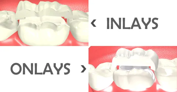 Dental Inlay & Onlay : What's The Difference Dental Inlay & Onlay : What's The Difference