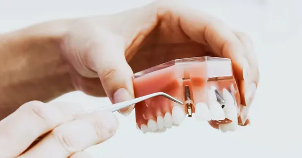 7 Myths Surrounding Dental Implants | Rancho Mirage, CA 7 Myths Surrounding Dental Implants | Rancho Mirage, CA