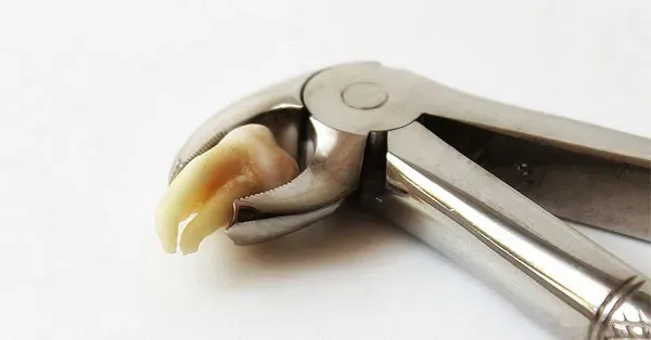 Top 6 Benefits of Tooth Extraction in Yucca Valley
